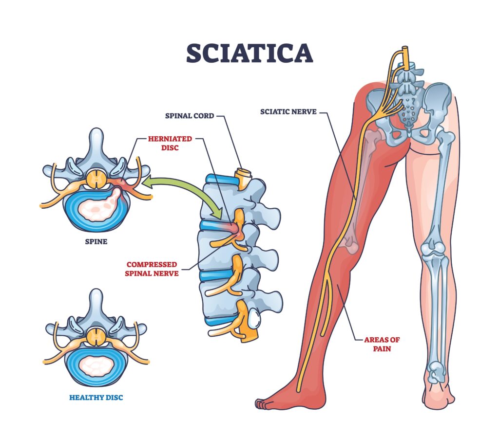 sciatica treatment Aurora CO